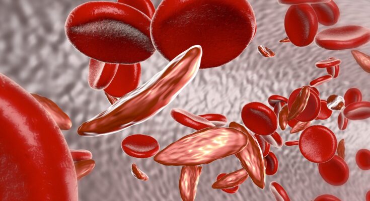Global Sickle Cell Anemia Therapeutics Market