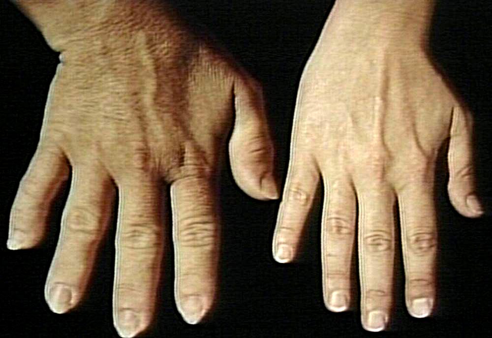 Acromegaly And Gigantism Treatment Market Size, Industry